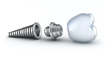 dental implants